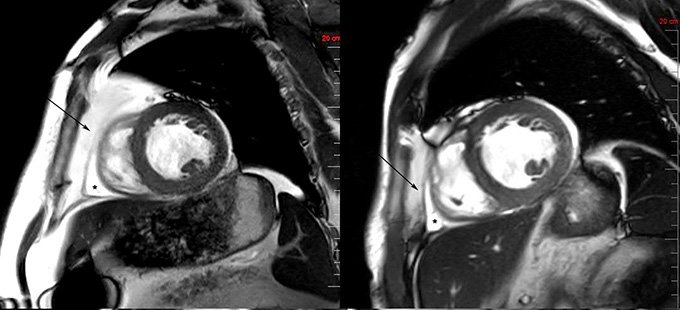 Two black and white MRI images of the heart, shown side by side. In the left image, which comes from a patient before they started tirzepatide, more fat appears to surround the heart.